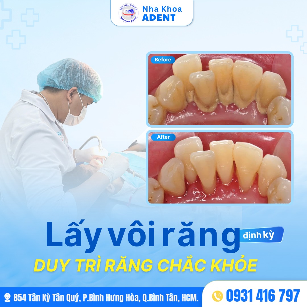 Cạo Vôi Răng, Đánh Bóng Làm Sạch, Tất Cả Những Điều Bạn Cần Biết