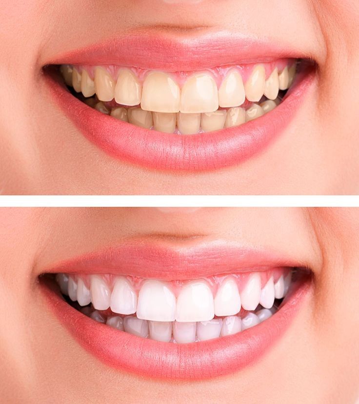Dịch Vụ Tẩy Trắng Răng Tại Nha Khoa Adent Giải Pháp Cho Nụ Cười Trắng Sáng (1)
