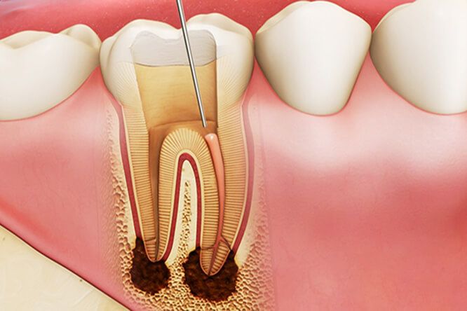 Điều Trị Tủy Răng – Nha Khoa Adent