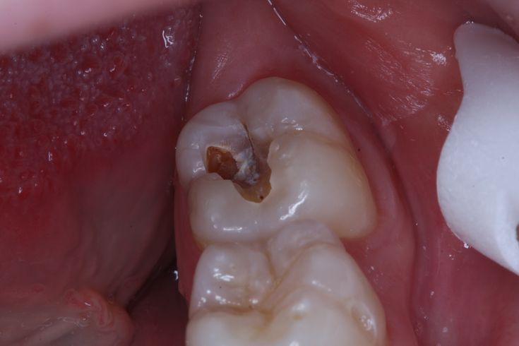 Điều Trị Tủy Răng – Nha Khoa Adent