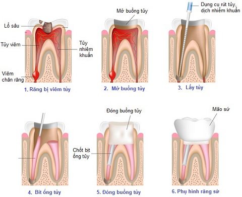 Điều Trị Tủy Răng – Nha Khoa Adent