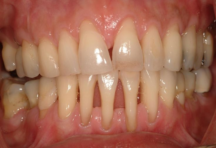 Điều Trị Viêm Nha Chu Hiệu Quả Tại Nha Khoa Adent – Bảo Vệ Sức Khỏe Răng Miệng Toàn Diện (1)