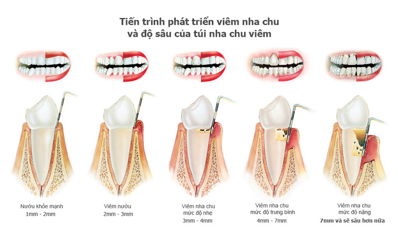 Điều Trị Viêm Nha Chu Hiệu Quả Tại Nha Khoa Adent – Bảo Vệ Sức Khỏe Răng Miệng Toàn Diện (2)