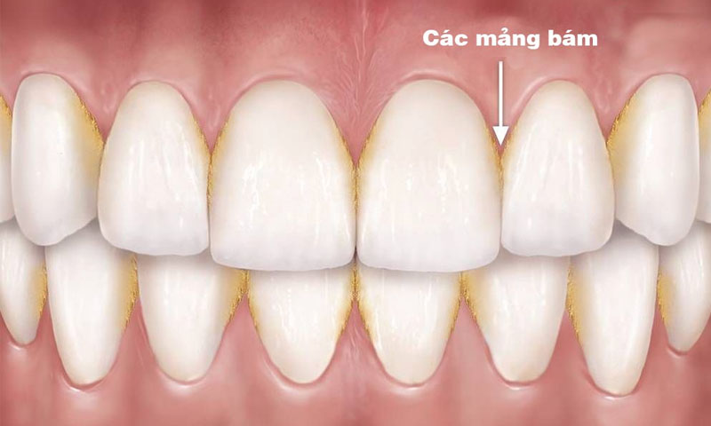Điều Trị Viêm Nha Chu Hiệu Quả Tại Nha Khoa Adent – Bảo Vệ Sức Khỏe Răng Miệng Toàn Diện (3)