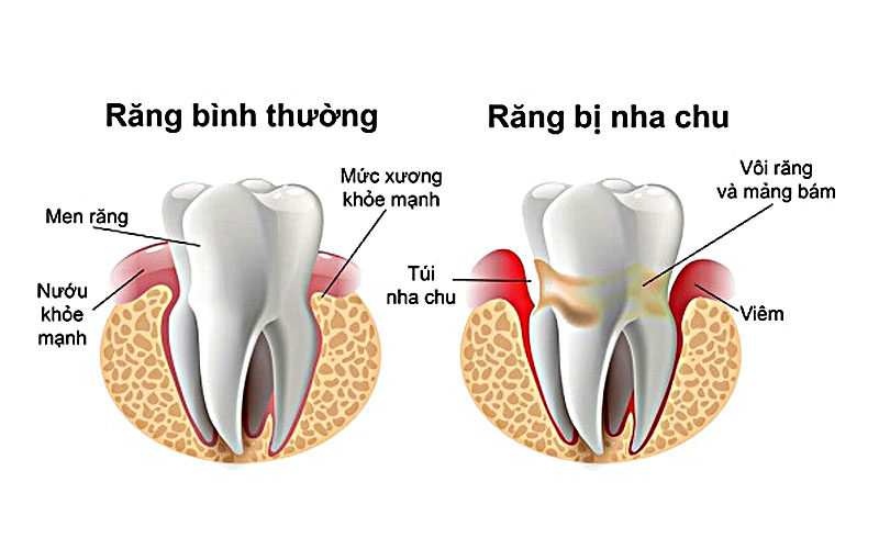Điều Trị Viêm Nha Chu Hiệu Quả Tại Nha Khoa Adent – Bảo Vệ Sức Khỏe Răng Miệng Toàn Diện (4)