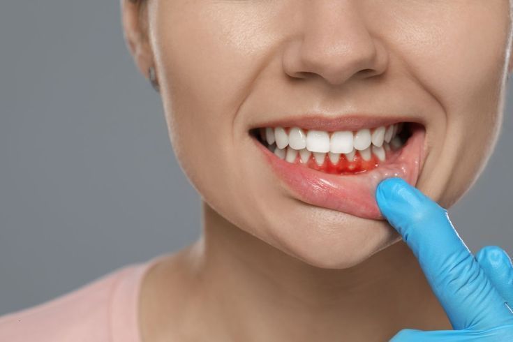 Điều Trị Viêm Nha Chu Hiệu Quả Tại Nha Khoa Adent – Bảo Vệ Sức Khỏe Răng Miệng Toàn Diện
