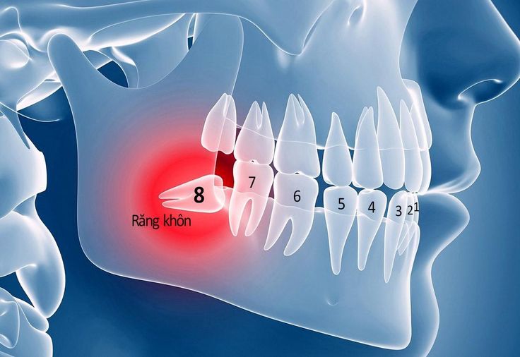 Nhổ Răng Khôn Tại Nha Khoa Adent – Không Đau, Không Biến Chứng