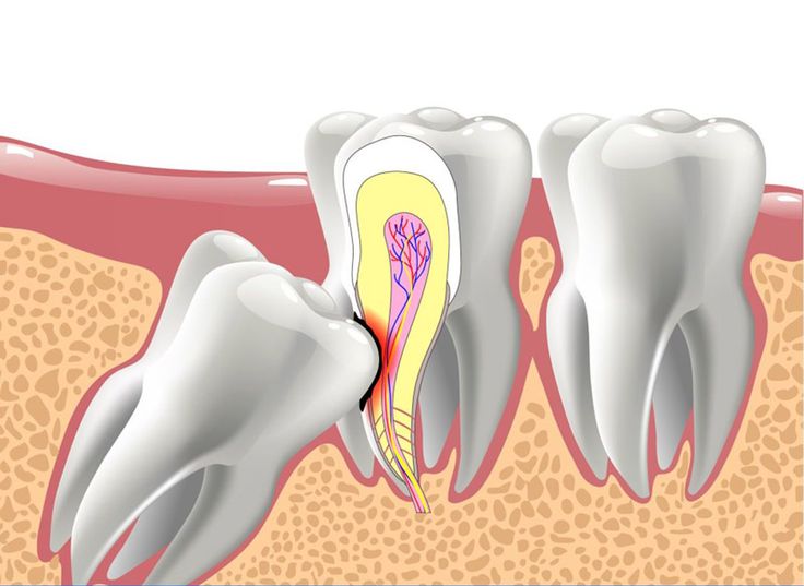 Nhổ Răng Khôn Tại Nha Khoa Adent – Không Đau, Không Biến Chứng