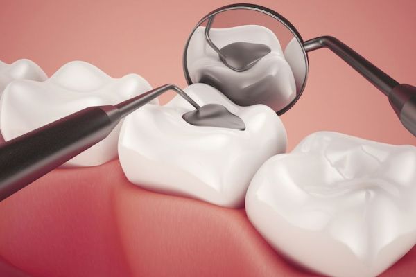 Trám Răng Là Gì Quy Trình Thực Hiện Như Thế Nào