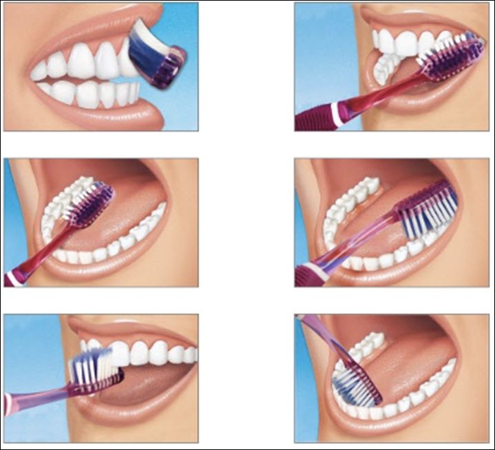 Trám Răng Là Gì Quy Trình Thực Hiện Như Thế Nào