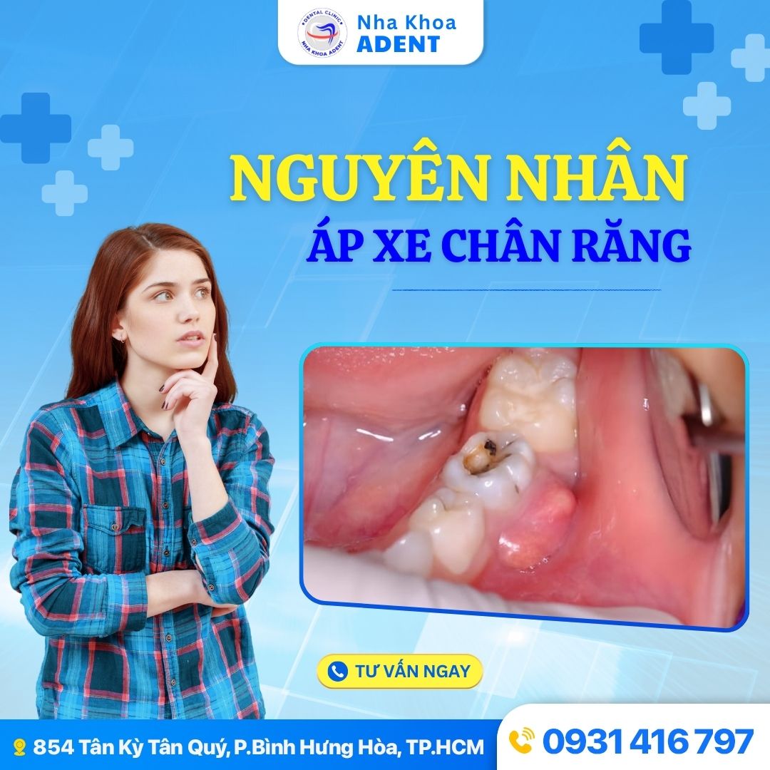 Áp Xe Chân Răng Nguyên Nhân, Dấu Hiệu Nhận Biết Và Cách Xử Lý Hiệu Quả (5)