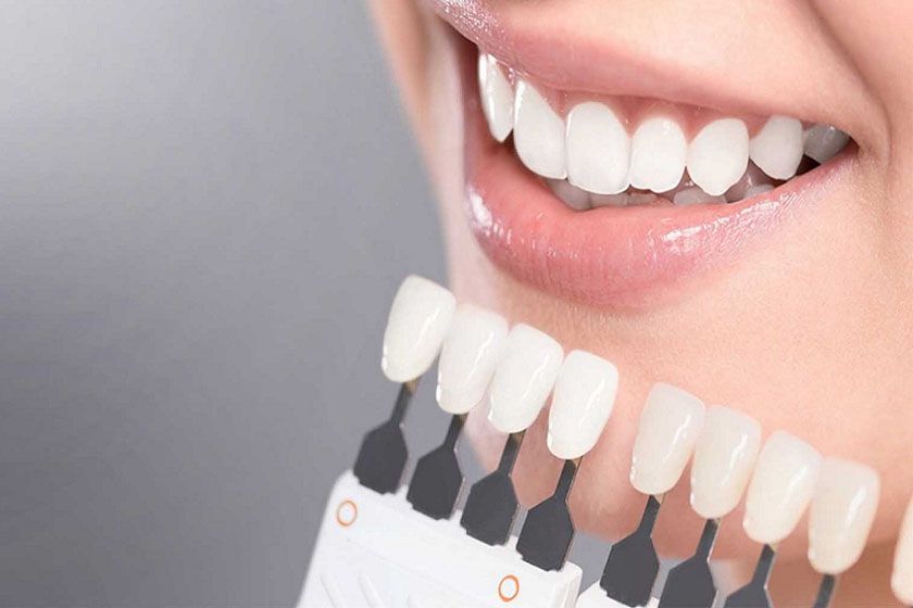 Bọc Răng Sứ Là Gì Có Những Loại Nào Và Cách Thực Hiện Chuẩn Nhất (2)