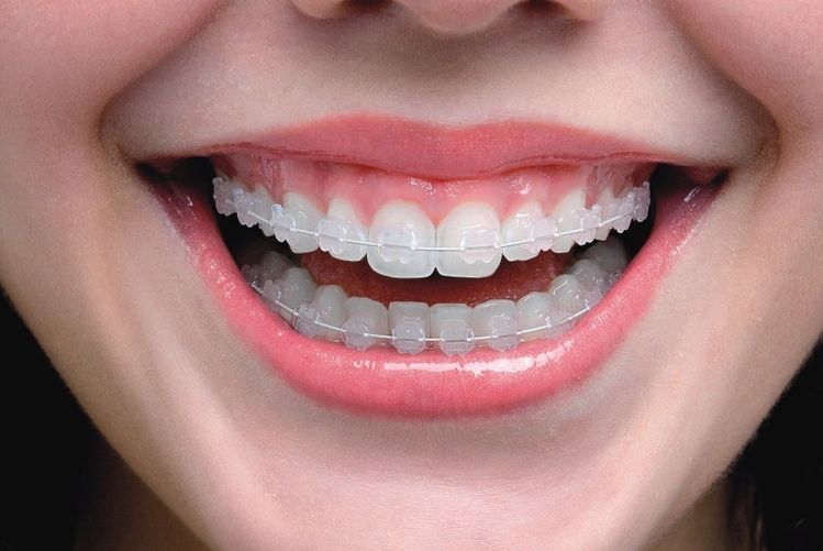 Chỉnh Nha Là Gì Tìm Hiểu Từ A-z Các Phương Pháp Chỉnh Nha Phổ Biến Hiện Nay (1)