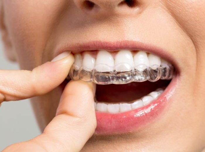 Chỉnh Nha Là Gì Tìm Hiểu Từ A-z Các Phương Pháp Chỉnh Nha Phổ Biến Hiện Nay (2)
