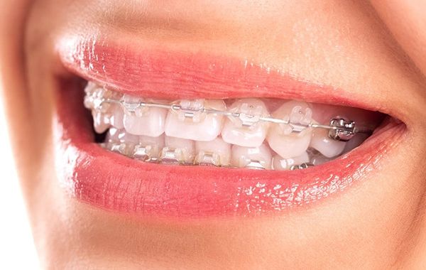 Chỉnh Nha Là Gì Tìm Hiểu Từ A-z Các Phương Pháp Chỉnh Nha Phổ Biến Hiện Nay (3)