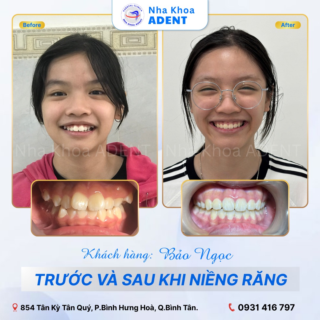Chỉnh Nha Là Gì Tìm Hiểu Từ A-z Các Phương Pháp Chỉnh Nha Phổ Biến Hiện Nay (4)