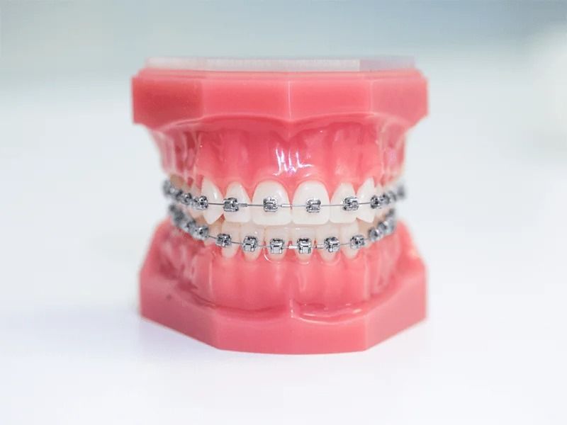 Niềng Răng Mắc Cài Kim Loại Phương Pháp, Chi Phí Và Quy Trình Điều Trị (1)
