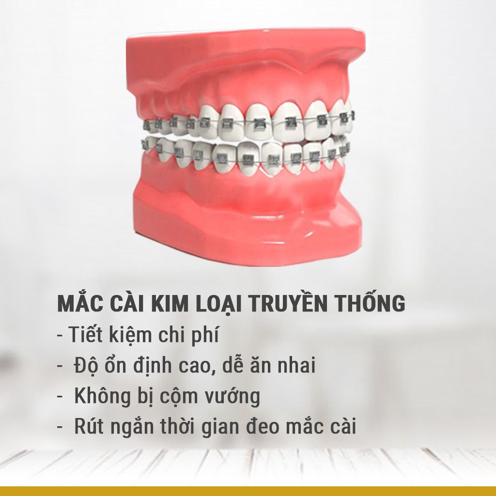 Niềng Răng Mắc Cài Kim Loại Phương Pháp, Chi Phí Và Quy Trình Điều Trị (5)