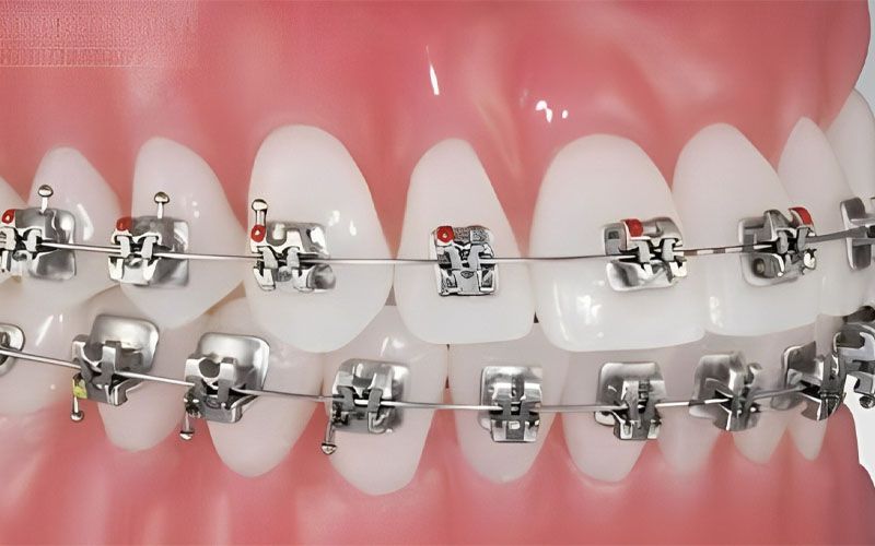 Niềng Răng Mắc Cài Kim Loại Phương Pháp, Chi Phí Và Quy Trình Điều Trị (6)