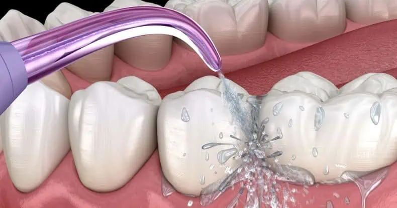 Niềng Răng Mắc Cài Sứ – Lựa Chọn Thẩm Mỹ Hiện Đại Cho Nụ Cười Đều Đẹp Tại Nha Khoa Adent (6)