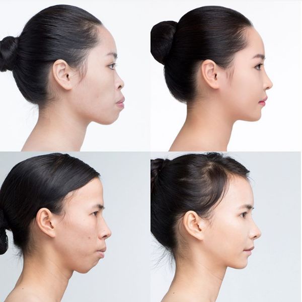 Niềng Răng Trong Suốt Invisalign – Giải Pháp Chỉnh Nha Thẩm Mỹ Hiện Đại (1)