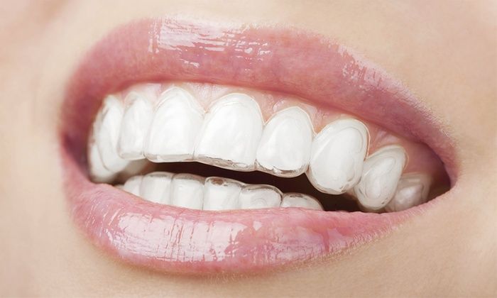 Niềng Răng Trong Suốt Invisalign – Giải Pháp Chỉnh Nha Thẩm Mỹ Hiện Đại (8)