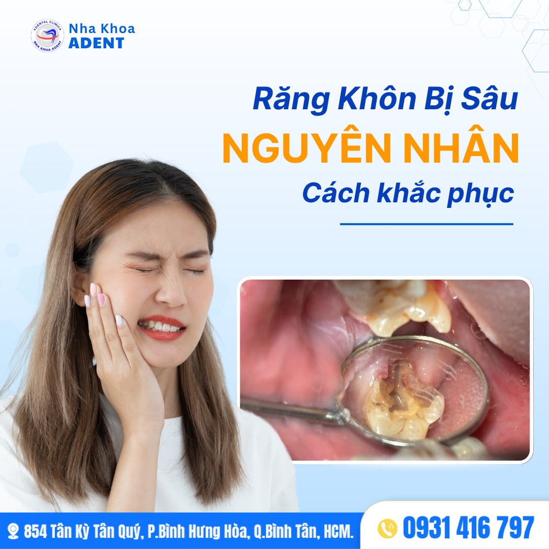 Răng Khôn Bị Sâu Nguyên Nhân, Tác Hại Và Giải Pháp Điều Trị Hiệu Quả (2)