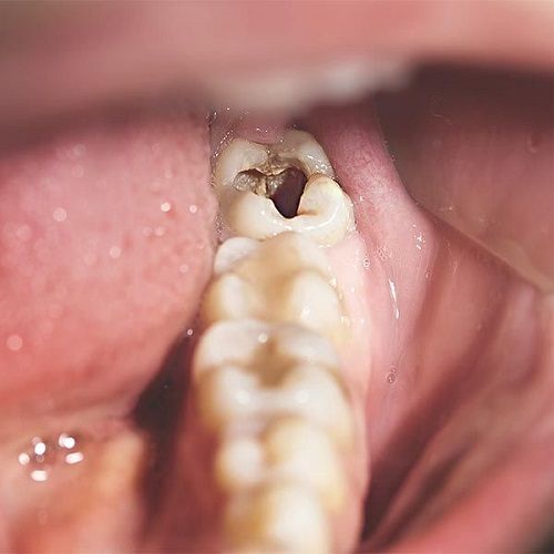 Răng Khôn Bị Sâu Nguyên Nhân, Tác Hại Và Giải Pháp Điều Trị Hiệu Quả