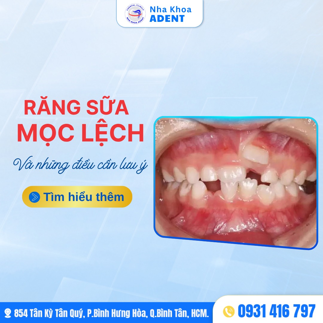 Răng Sữa Mọc Lệch Ở Trẻ – Cha Mẹ Không Nên Xem Nhẹ!