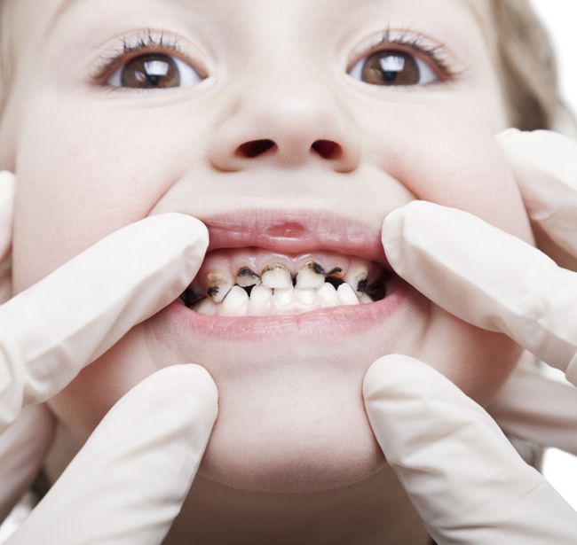 Răng Sữa Mọc Lệch Ở Trẻ – Cha Mẹ Không Nên Xem Nhẹ!