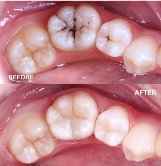 Trám Răng Sâu Nặng – Có Nên Hay Không Sự Thật Bạn Cần Biết Ngay! (3)