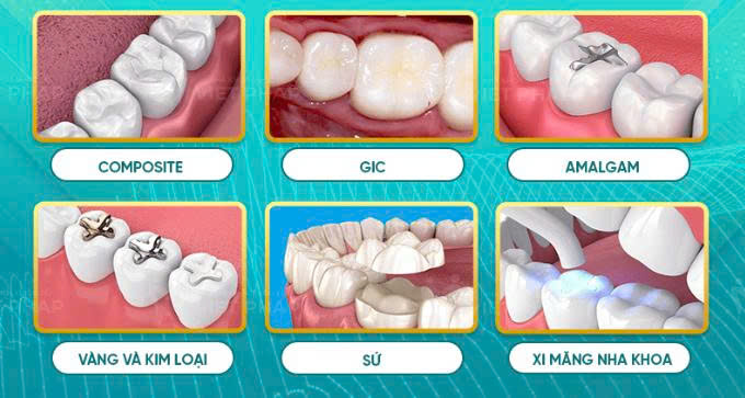 Trám Răng Sâu Nặng – Có Nên Hay Không Sự Thật Bạn Cần Biết Ngay! (5)