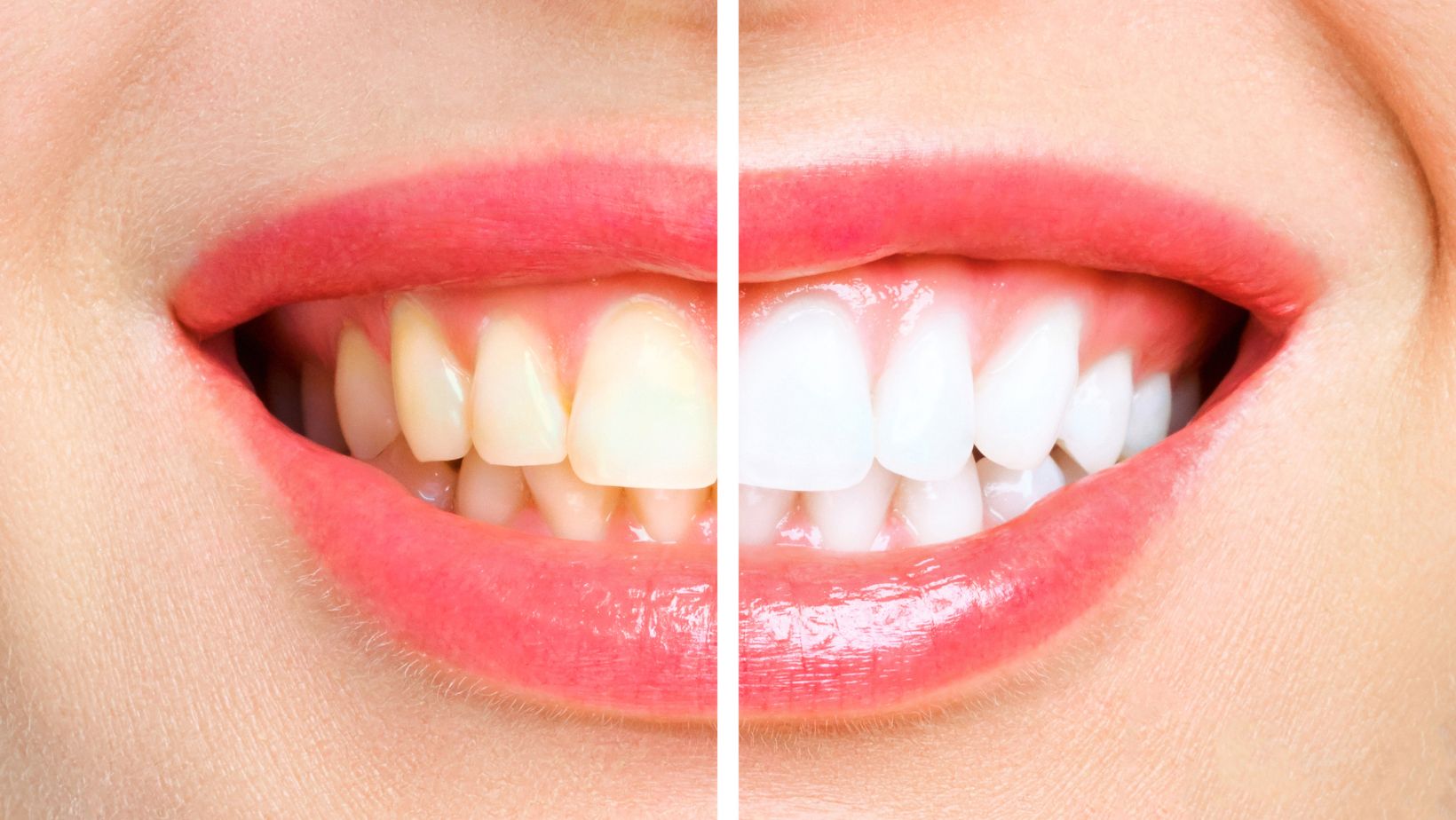 Tẩy Trắng Răng 2 Ảnh Bìa Nha Khoa (1)
