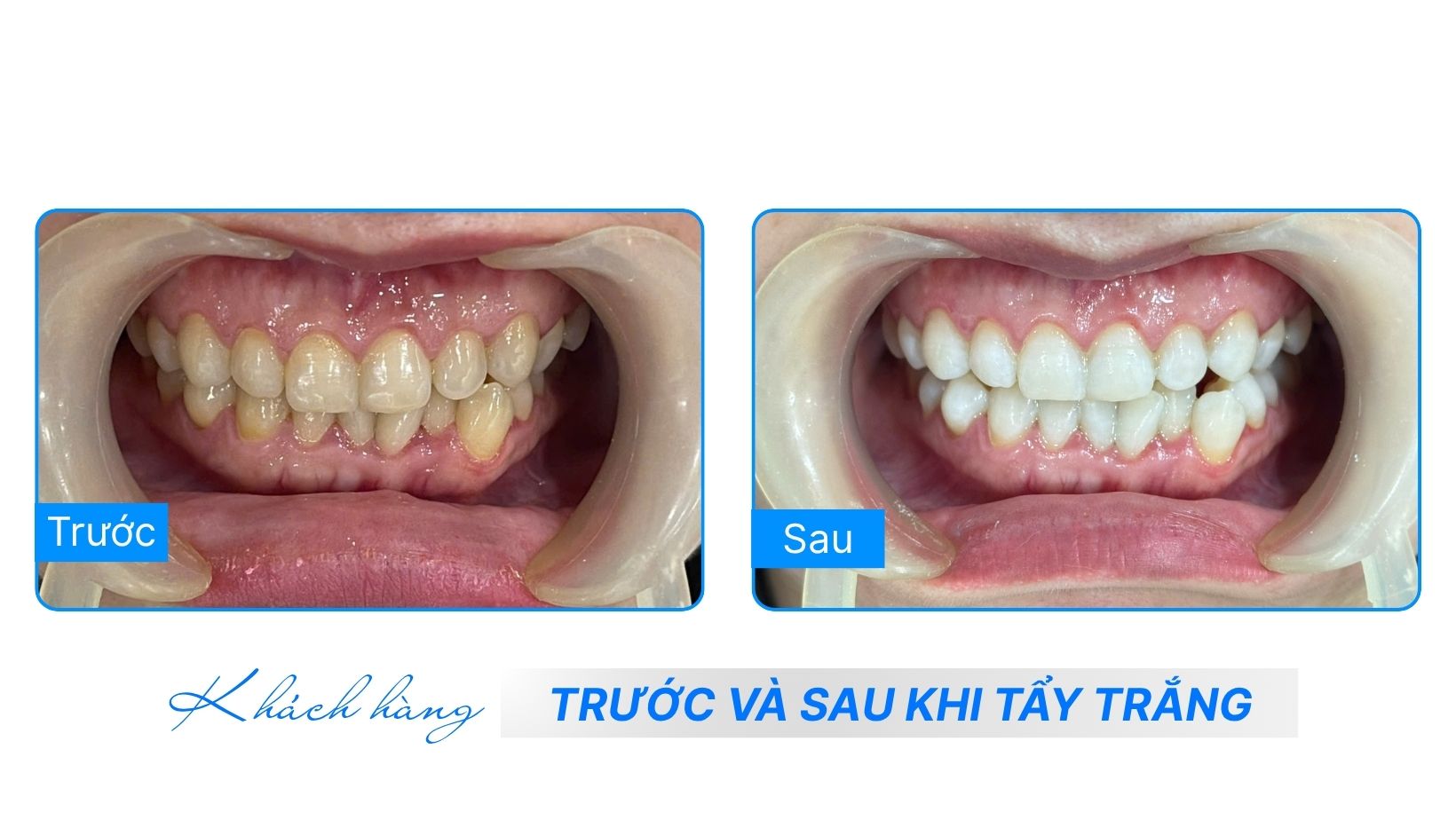 Tẩy Trắng Răng 4 Hình ảnh Khách hàng trước và sau khi tẩy trắng răng tại Nha Khoa ADENT