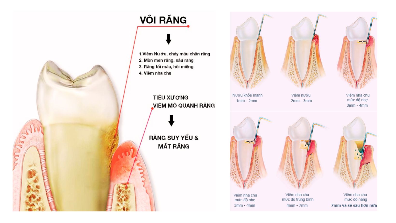Cạo Vôi Răng 3 Hậu quả của vôi răng - Nha Khoa ADENT