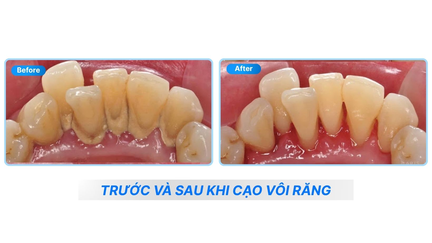 Cạo Vôi Răng 4 Trước và sau khi cạo vôi răng - Nha Khoa ADENT
