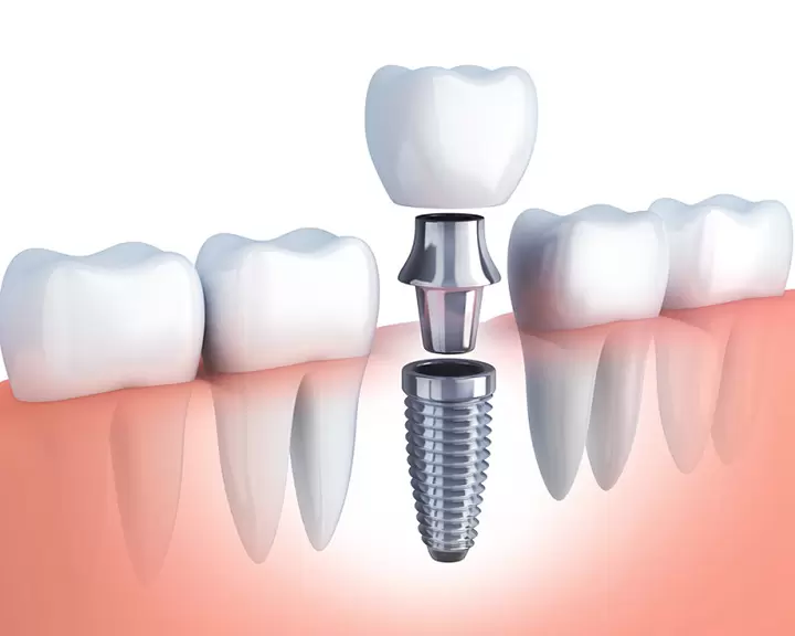 trồng răng implant - nha khoa adent