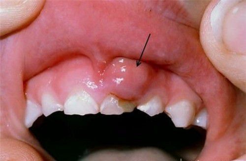 Áp Xe Răng: Nguyên Nhân, Dấu Hiệu Và Cách Điều Trị 3 Áp Xe Răng Nguyên Nhân, Dấu Hiệu Và Cách Điều Trị