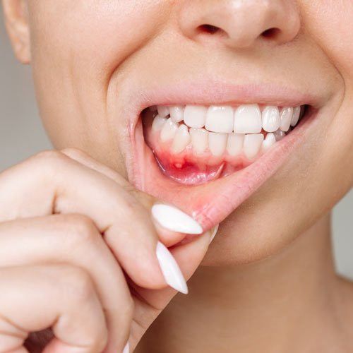 Áp Xe Răng: Nguyên Nhân, Dấu Hiệu Và Cách Điều Trị 4 Áp Xe Răng Nguyên Nhân, Dấu Hiệu Và Cách Điều Trị