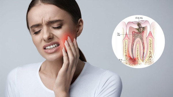 Áp Xe Răng: Nguyên Nhân, Dấu Hiệu Và Cách Điều Trị 6 Áp Xe Răng Nguyên Nhân, Dấu Hiệu Và Cách Điều Trị