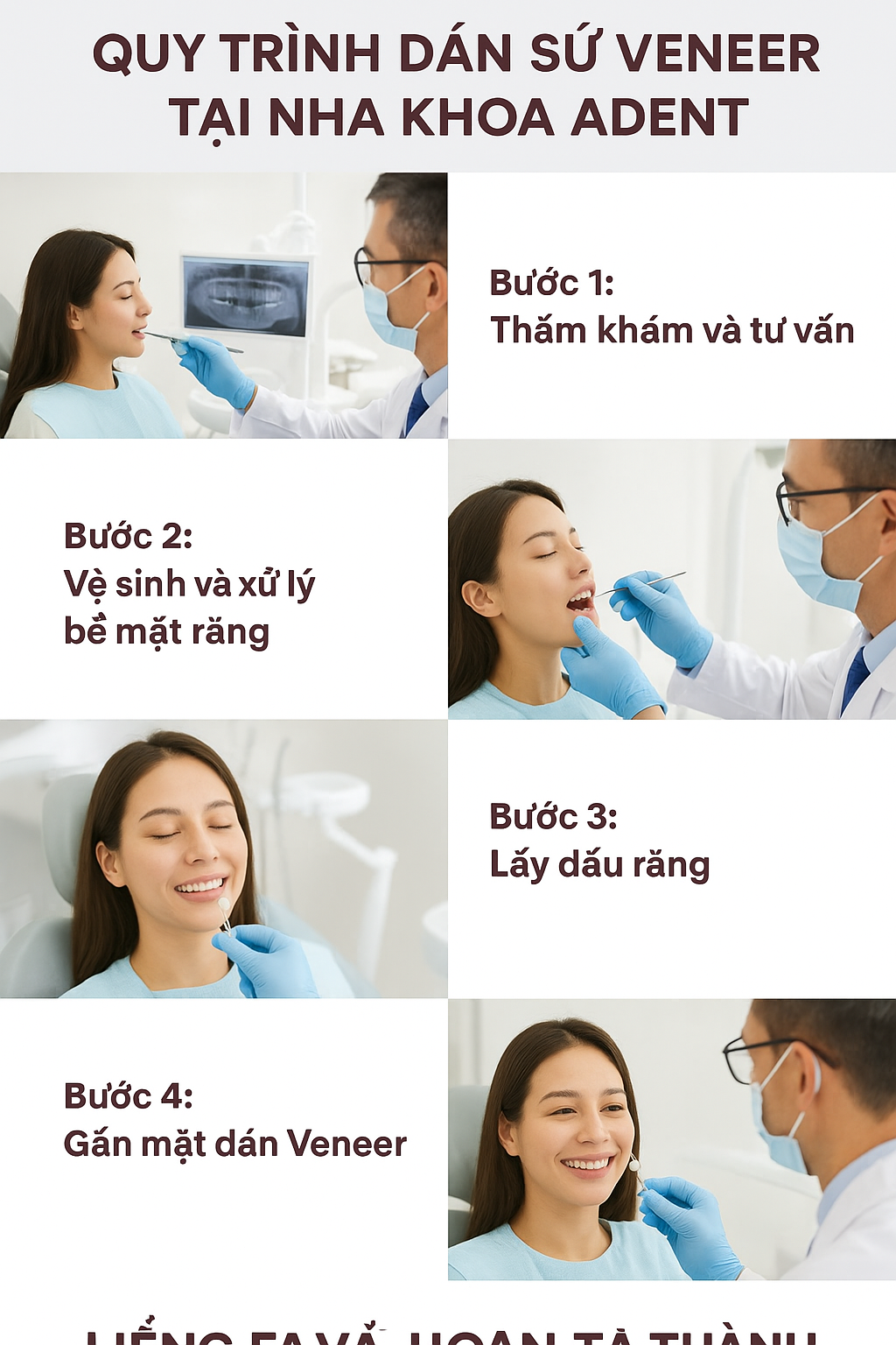 Dán Sứ Veneer (1)