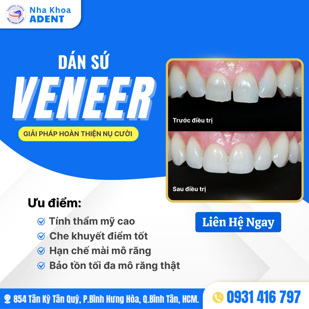 Dán Sứ Veneer
