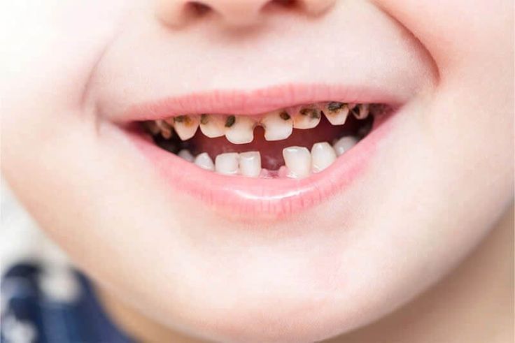 Nhổ Răng Sữa Cho Trẻ