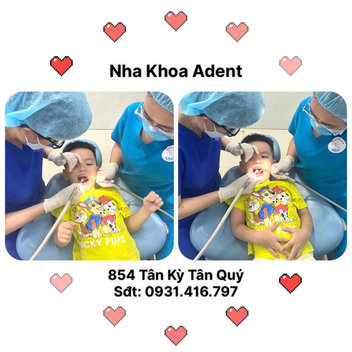 Nhổ Răng Sữa Cho Trẻ