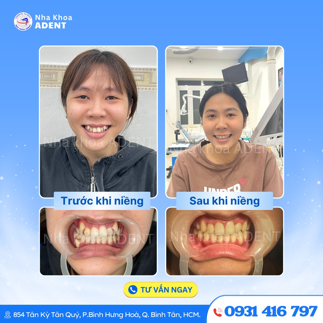 Niềng Răng Trong Suốt Mất Bao Lâu Chi Phí Bao Nhiêu