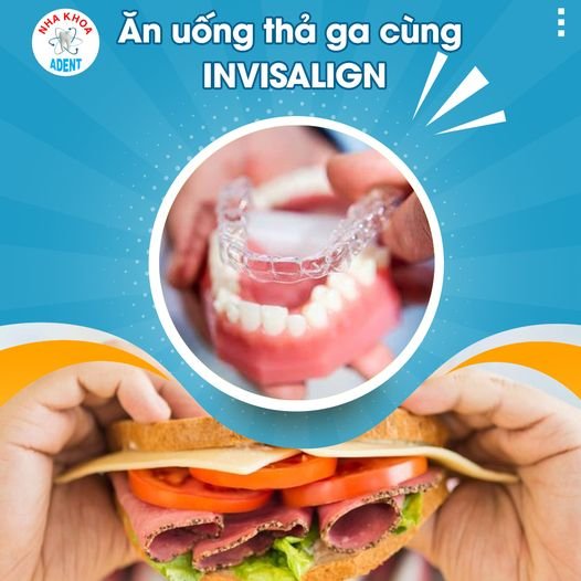 Niềng Răng Trong Suốt Mất Bao Lâu Chi Phí Bao Nhiêu