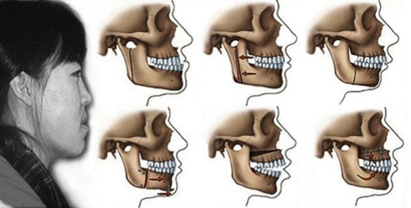 Niềng Răng Trong Suốt Mất Bao Lâu Chi Phí Bao Nhiêu