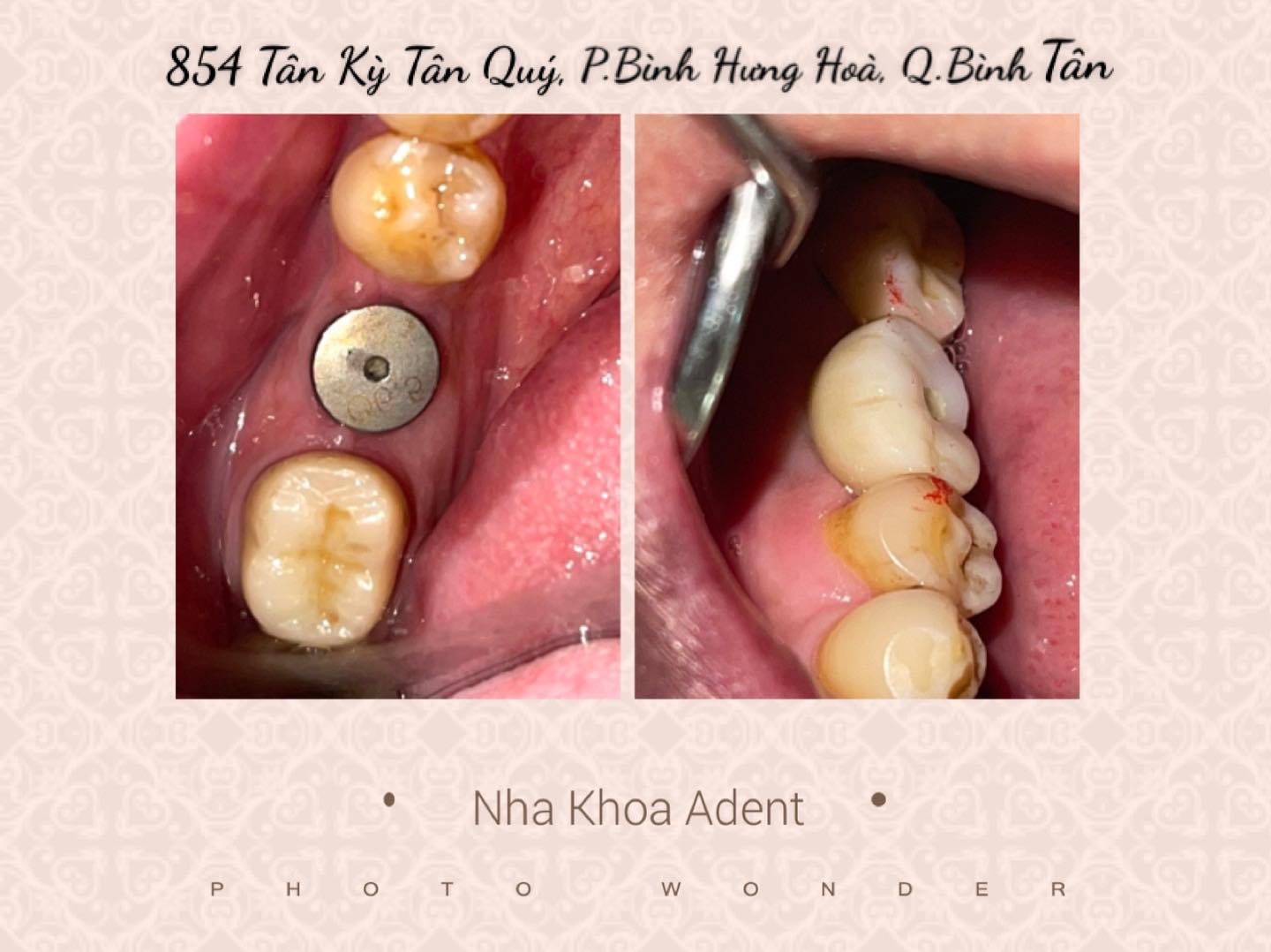 Phục Hình Răng Sứ Trên Implant Là Gì Quy Trình Và Những Điều Cần Biết (3)