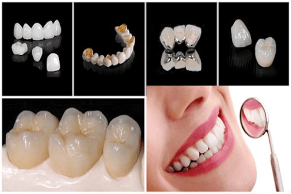 Phục Hình Răng Sứ Trên Implant Là Gì Quy Trình Và Những Điều Cần Biết (3)