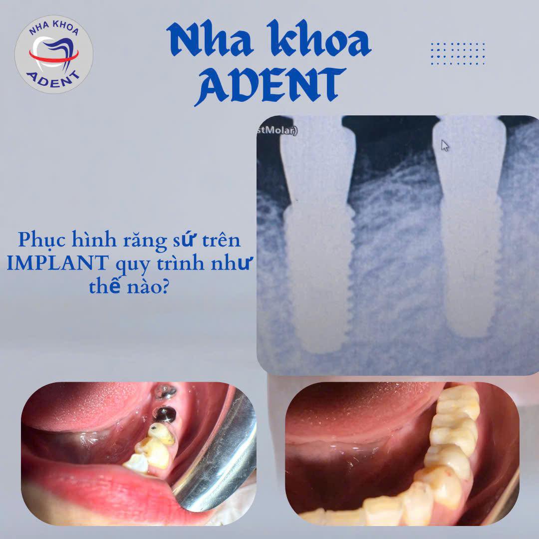 Phục Hình Răng Sứ Trên Implant Là Gì Quy Trình Và Những Điều Cần Biết (4)
